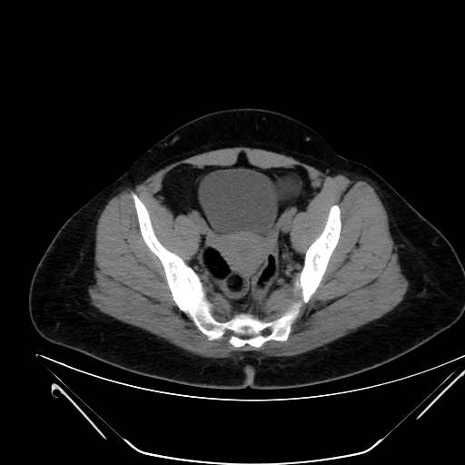 Bilateral ovarian mature cystic teratomas (Radiopaedia 79373-92457 Axial non-contrast 62).jpg