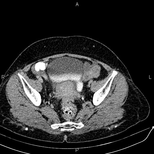 Bilateral ovarian serous cystadenocarcinoma (Radiopaedia 86062-101989 Axial C+ delayed 67).jpg