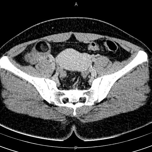 Bilateral ovarian teratoma (Radiopaedia 83131-97503 B 30).jpg