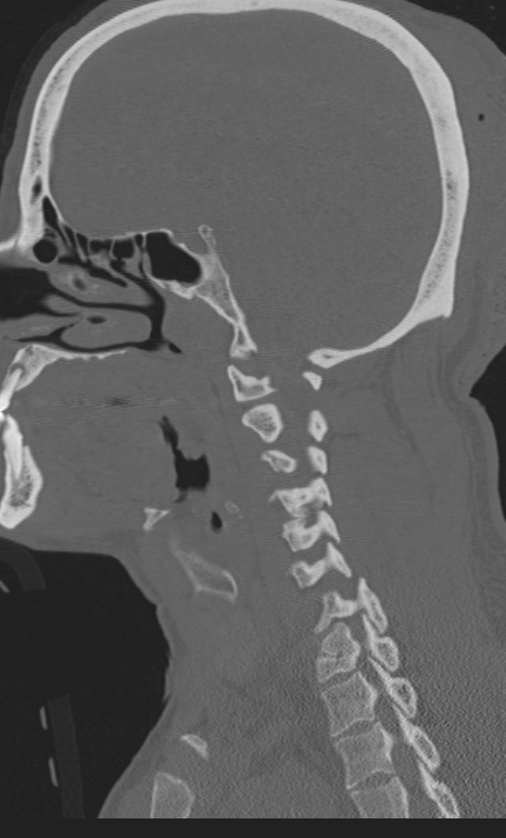 Bilateral perched facet joint (Radiopaedia 63149-71669 Sagittal bone window 14).jpg
