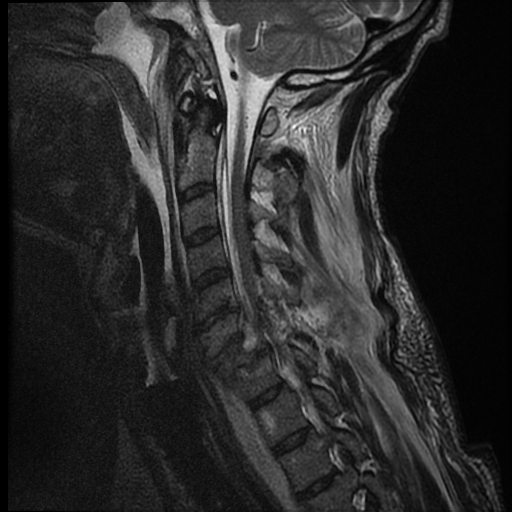 File:Bilateral perched facets with cord injury (Radiopaedia 45587-49714 Sagittal T2 10).jpg