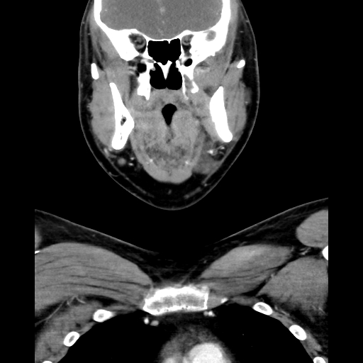 Bilateral peritonsillar abscess (Radiopaedia 85065-100610 Coronal 28).jpg