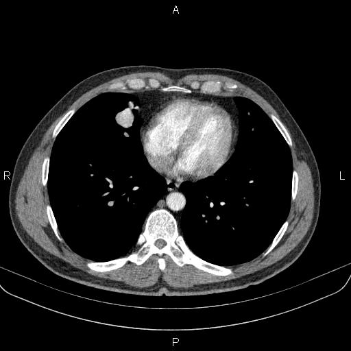 File:Bilateral pulmonary AVM (Radiopaedia 83134-97505 A 50).jpg