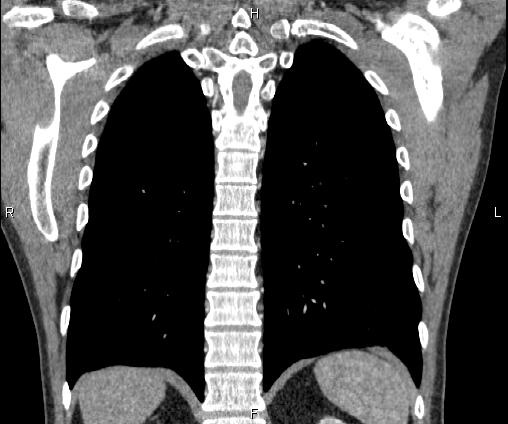 Bilateral pulmonary AVM (Radiopaedia 83134-97505 C 56).jpg