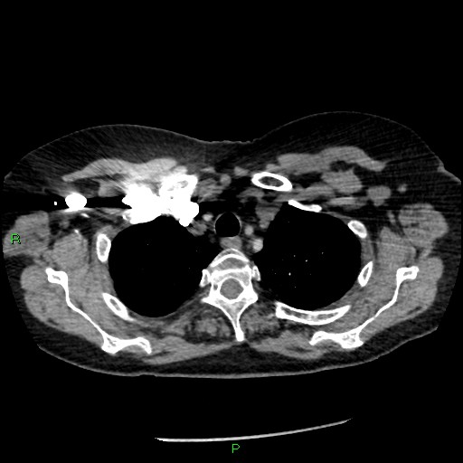 Bilateral pulmonary emboli (Radiopaedia 32700-33669 Axial C+ CTPA 15).jpg