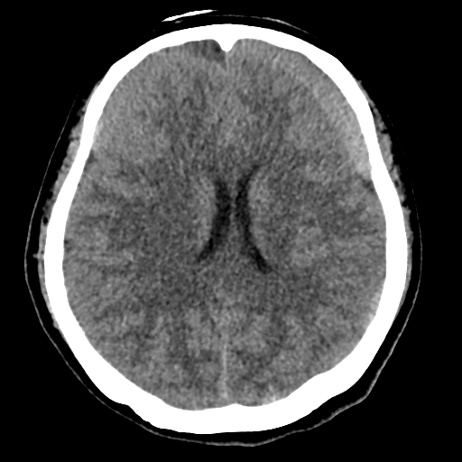 Bilateral subacute subdural hematoma (Radiopaedia 69240-79018 Axial non-contrast 29).jpg