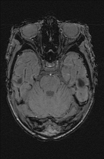 File:Bilateral subdural hemorrhage and parietal skull fracture (Radiopaedia 26058-26190 Axial SWI 19).png