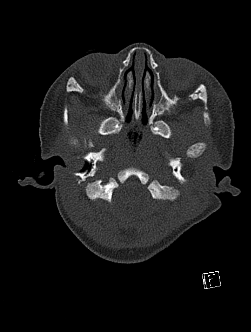 Bilateral subdural hemorrhage and parietal skull fracture (Radiopaedia 26058-26192 Axial bone window 117).png