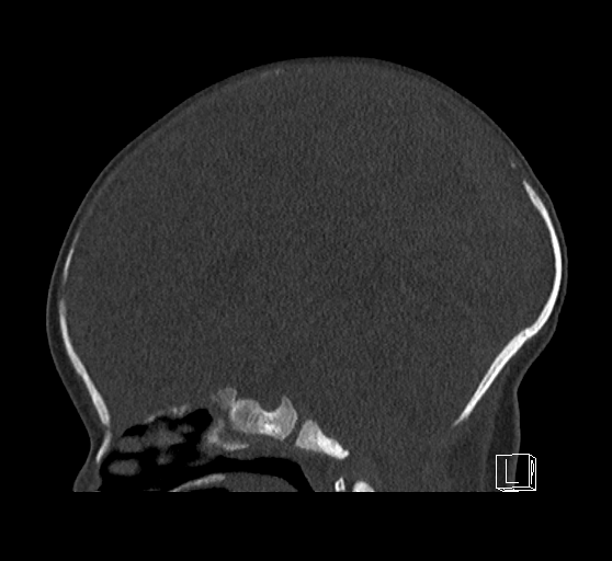 Bilateral subdural hemorrhage and parietal skull fracture (Radiopaedia 26058-26192 Sagittal bone window 47).png
