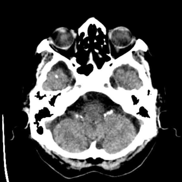 Bilateral subdural hygromata (Radiopaedia 29245-29656 Axial non-contrast 8).jpg