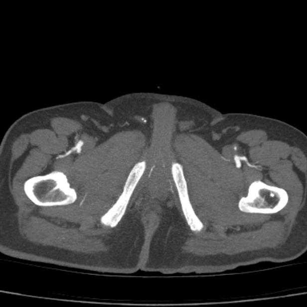Bilateral superficial femoral arterial occlusion (Radiopaedia 25682-25857 A 30).jpg