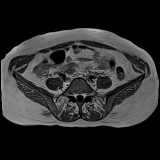 Bilateral tubo-ovarian abscesses (Radiopaedia 58635-65829 Axial T1 C+ 4).jpg