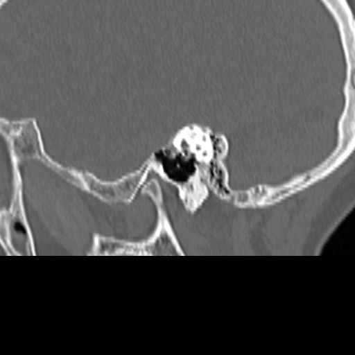 Bilateral tympanoplasty (Radiopaedia 16947-16664 Sagittal bone window 27).jpg
