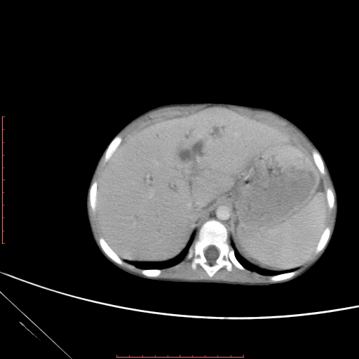 Biliary tract embryonal rhabdomyosarcoma (Radiopaedia 51815-57648 A 15).jpg