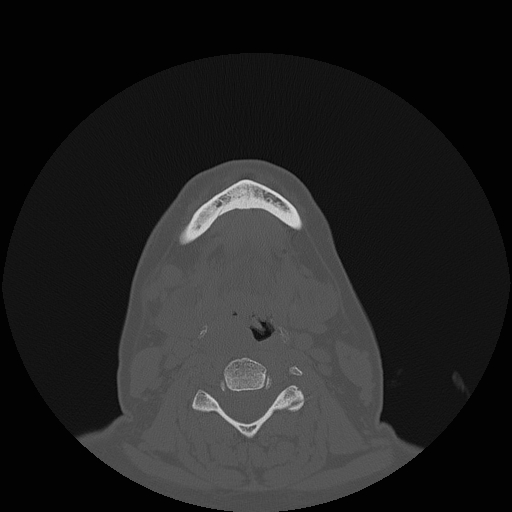 File:Bisphosphonate-related osteonecrosis of the jaw (Radiopaedia 71324-81642 Axial bone window 21).jpg