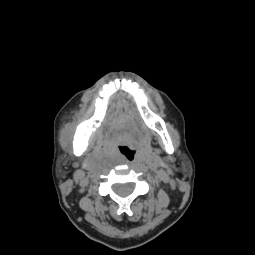 File:Bisphosphonate-related osteonecrosis of the jaw (Radiopaedia 71324-81642 non-contrast 61).jpg