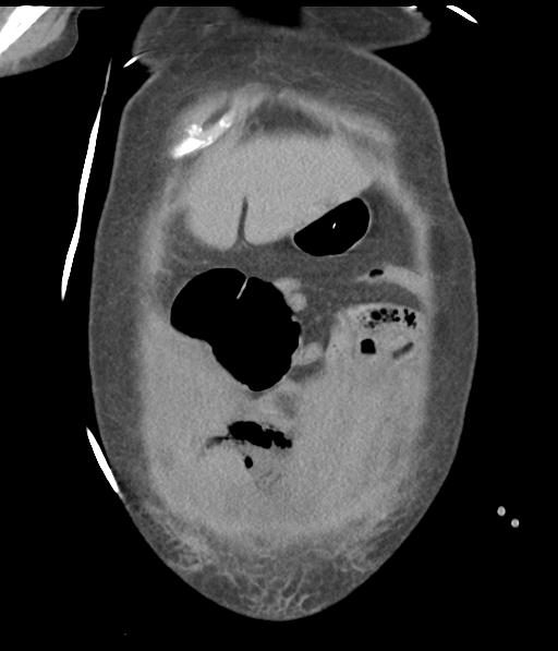 Bladder rupture post renal biopsy (Radiopaedia 30863-31572 Coronal non-contrast 12).jpg