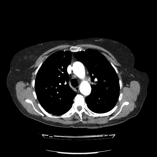 Bladder tumor detected on trauma CT (Radiopaedia 51809-57609 A 37).jpg
