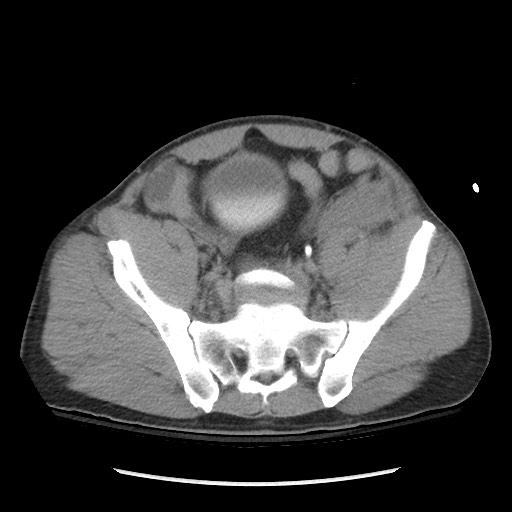 Blunt abdominal trauma with solid organ and musculoskelatal injury with active extravasation (Radiopaedia 68364-77895 Axial C+ delayed 108).jpg