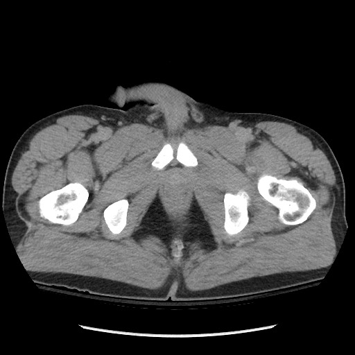 File:Blunt abdominal trauma with solid organ and musculoskelatal injury with active extravasation (Radiopaedia 68364-77895 Axial C+ delayed 142).jpg