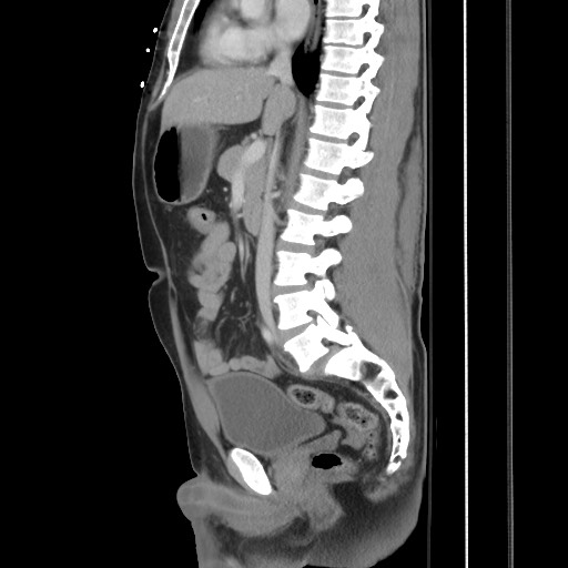 Blunt abdominal trauma with solid organ and musculoskelatal injury with active extravasation (Radiopaedia 68364-77895 C 71).jpg