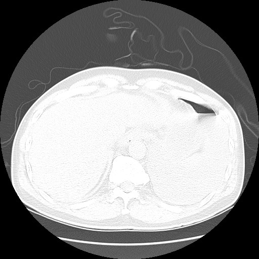 File:Boerhaave syndrome (Radiopaedia 59796-67310 Axial lung window 54).jpg