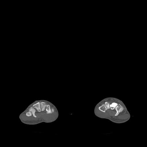 Bone islands - carpus (Radiopaedia 63141-71658 Axial bone window 32).jpg