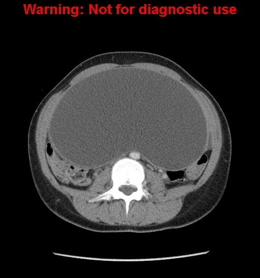 Borderline mucinous cystadenoma of ovary (Radiopaedia 25586-25767 A 33).jpg