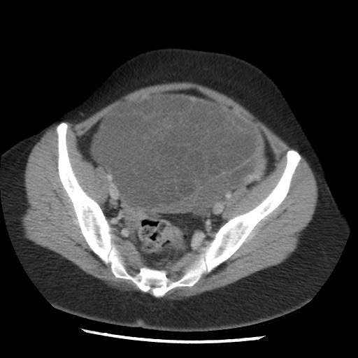File:Borderline mucinous tumor (ovary) (Radiopaedia 78228-90808 A 121).jpg