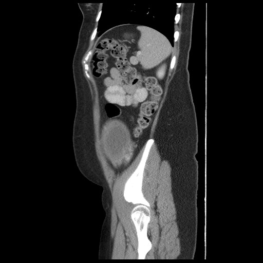 File:Borderline mucinous tumor (ovary) (Radiopaedia 78228-90808 B 53).jpg