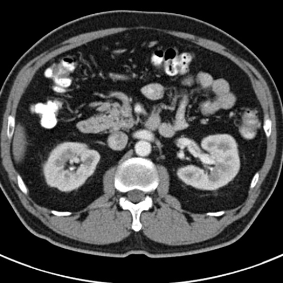 File:Bosniak cyst - type IV (Radiopaedia 23525-23627 renal cortical phase 21).jpg