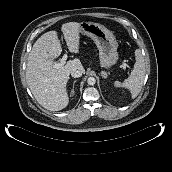Bosniak renal cyst - type IV (Radiopaedia 24244-24518 C 70).jpg
