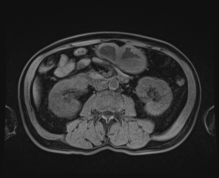 Bouveret syndrome (Radiopaedia 61017-68856 Axial T1 fat sat 48).jpg