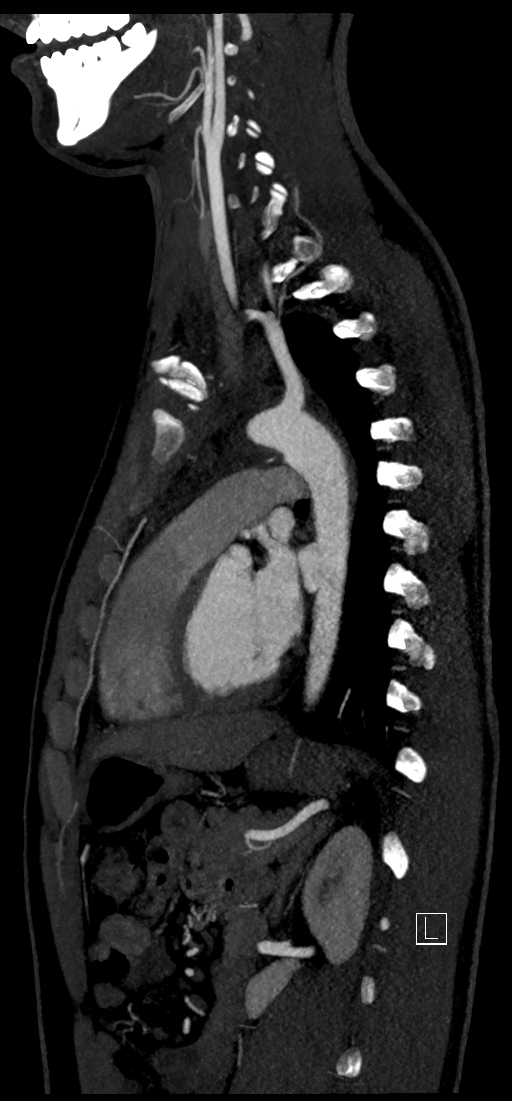 Brachiocephalic trunk pseudoaneurysm (Radiopaedia 70978-81191 C 59).jpg