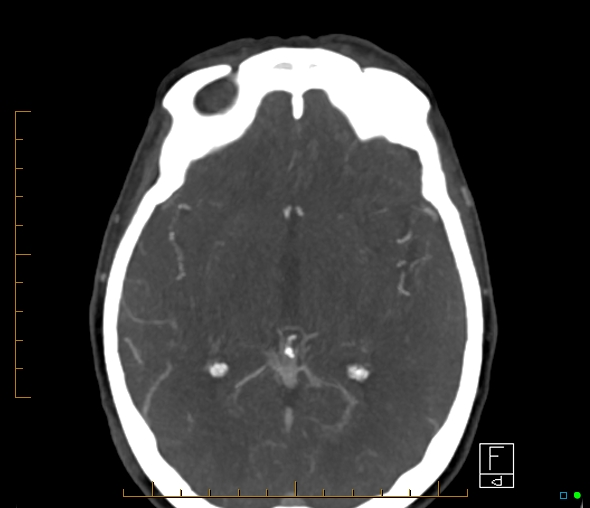 Brachiocephalic trunk stenosis (Radiopaedia 87242-103519 A 36).jpg