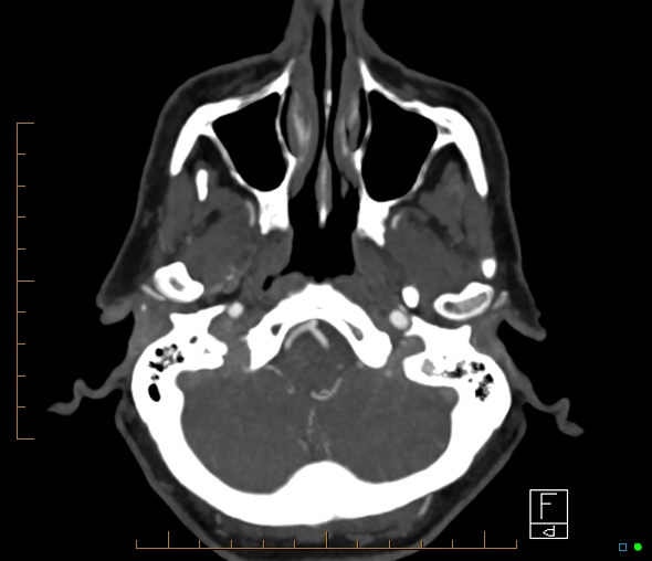 Brachiocephalic trunk stenosis (Radiopaedia 87242-103519 A 59).jpg