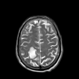 File:Brain abscess complicated by intraventricular rupture and ventriculitis (Radiopaedia 82434-96571 Axial T2 20).jpg