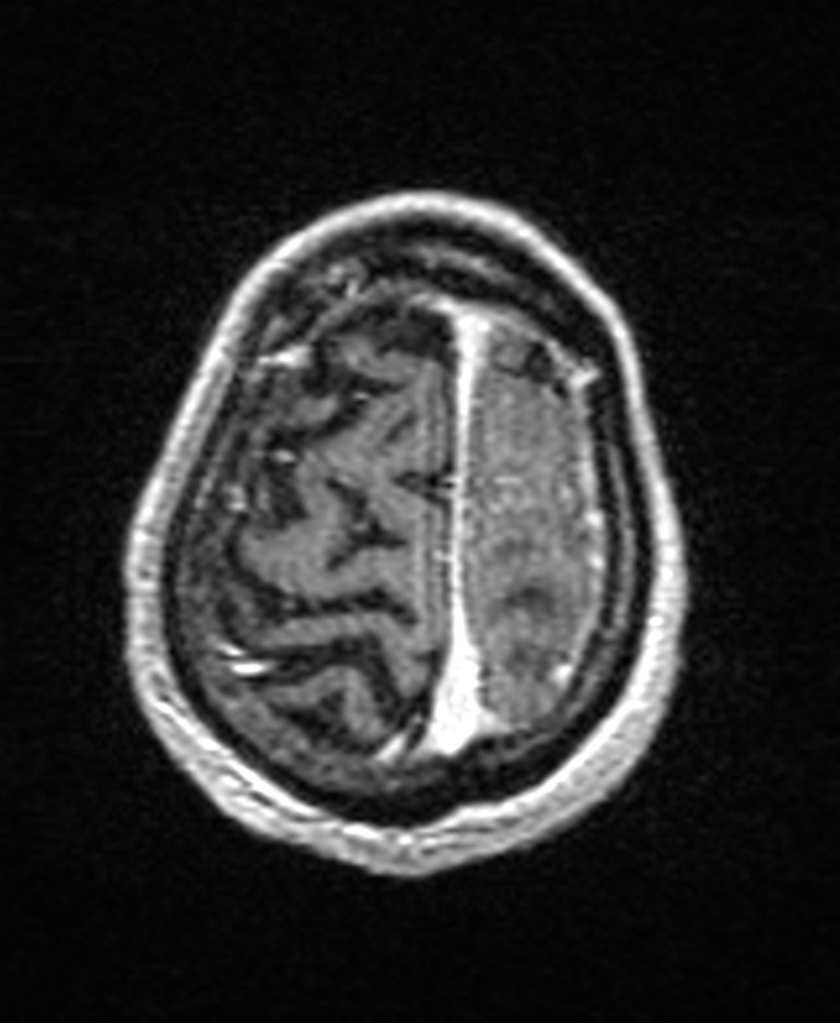 Brain abscess with dual rim sign (Radiopaedia 87566-103938 Axial T1 C+ 142).jpg