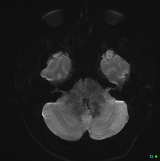 File:Brain death on MRI and CT angiography (Radiopaedia 42560-45689 Axial DWI 6).jpg