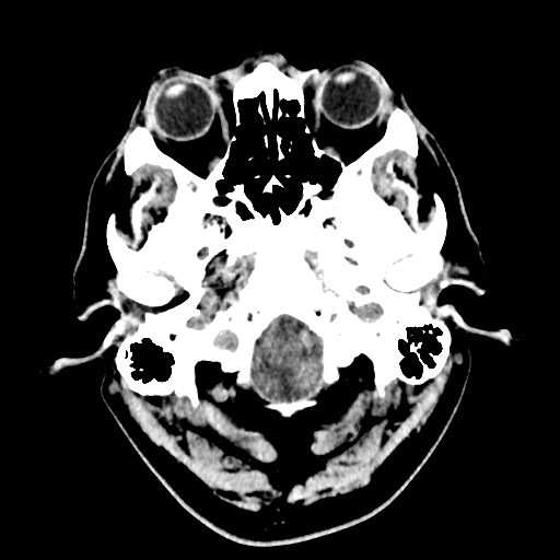File:Brain metastases from lung cancer (Radiopaedia 83839-99027 Axial non-contrast 3).jpg
