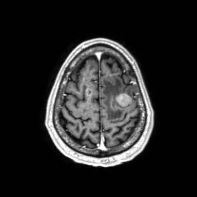 Brain metastases from lung cancer (Radiopaedia 83839-99028 Axial T1 C+ 58).jpg