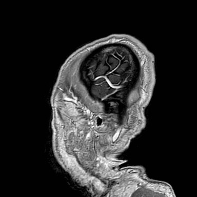 Brain metastases from lung cancer (Radiopaedia 83839-99028 Sagittal T1 C+ 62).jpg