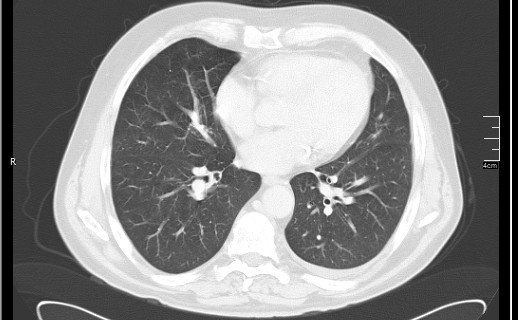 File:Brain metastases from squamocellular lung cancer (Radiopaedia 56515-63219 Axial lung window 40).jpg