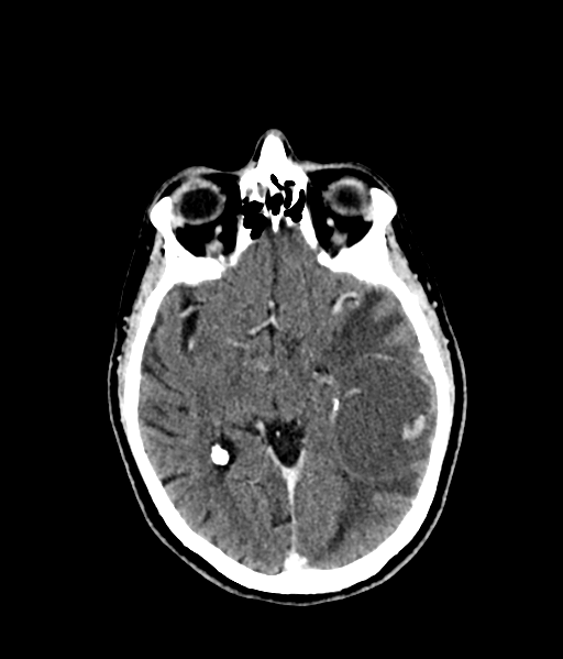 File:Brain metastasis (large cystic mass) (Radiopaedia 47497-52106 Axial C+ 30).png
