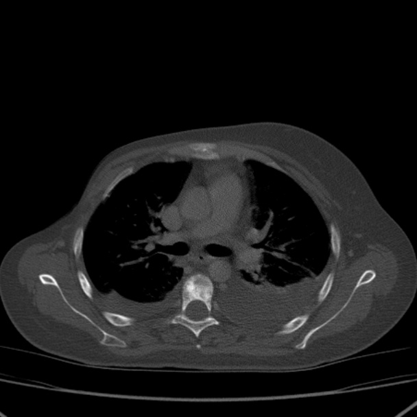 Breast cancer metastases - hepatic and skeletal (Radiopaedia 34201-35461 Axial bone window 17).jpg