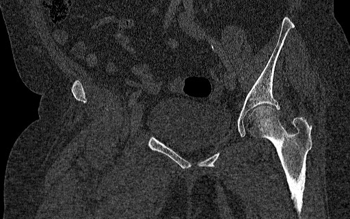 File:Breast carcinoma with pathological hip fracture (Radiopaedia 60314-67993 Coronal bone window 63).jpg