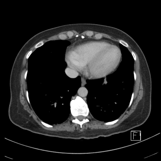 Breast metastases from renal cell cancer (Radiopaedia 79220-92225 C 2).jpg