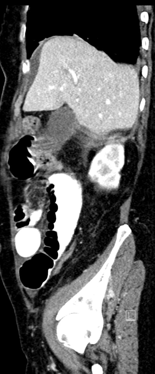 Broad ligament hernia (Radiopaedia 84802-100276 C 64).jpg