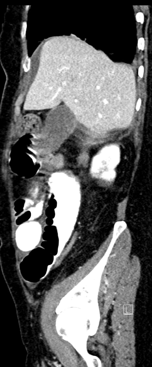 Broad ligament hernia (Radiopaedia 84802-100276 C 65).jpg