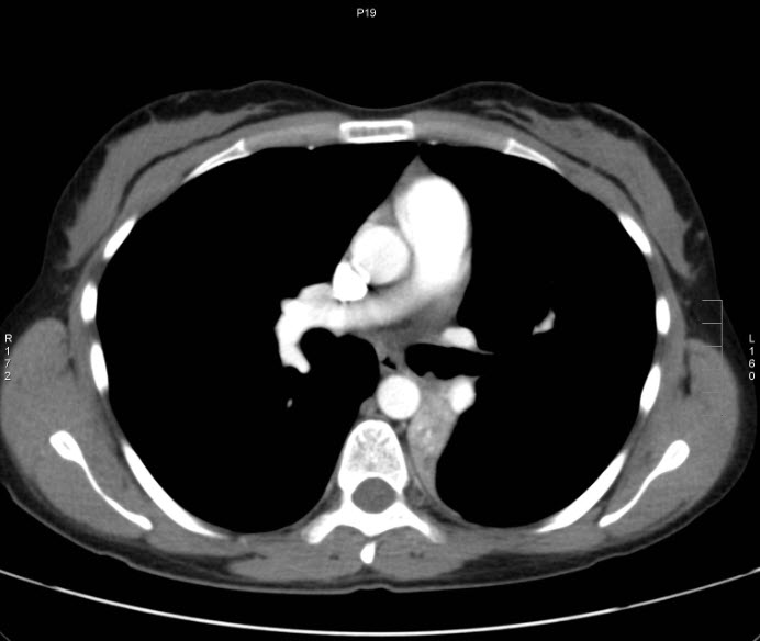 File:Bronchial carcinoid tumor (Radiopaedia 15042-42507 B 3).jpg